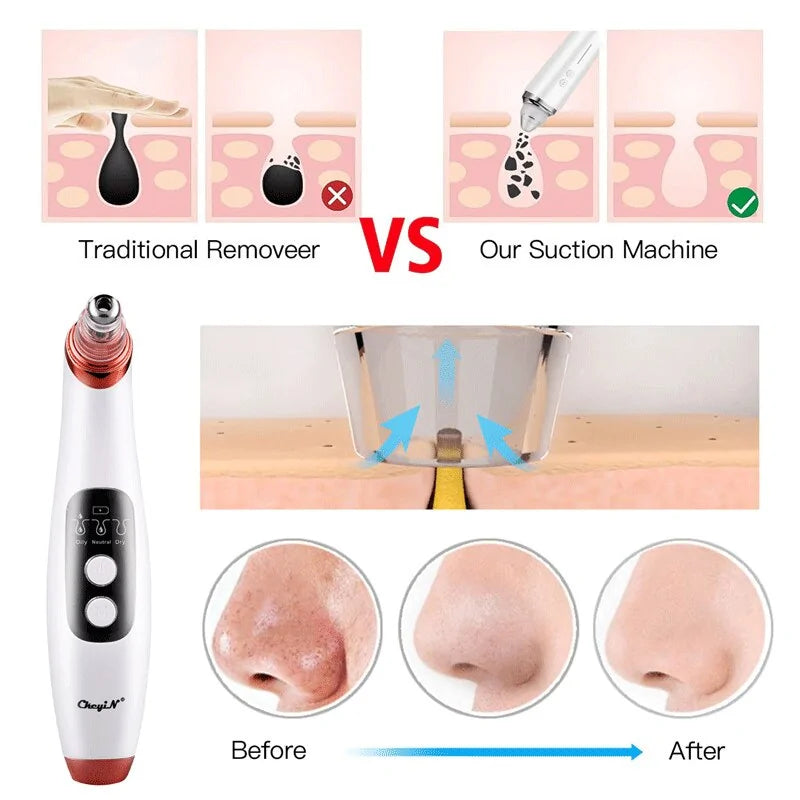 A Blackhead Remover Vacuum with Visual Camera and Pore Cleaner